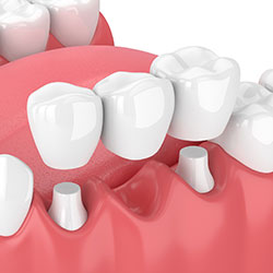 dental bridge illustration