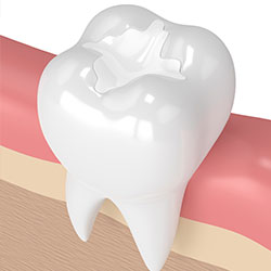 fillings illustration