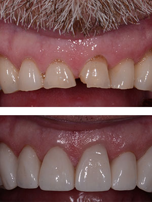 before and after teeth reconstruction