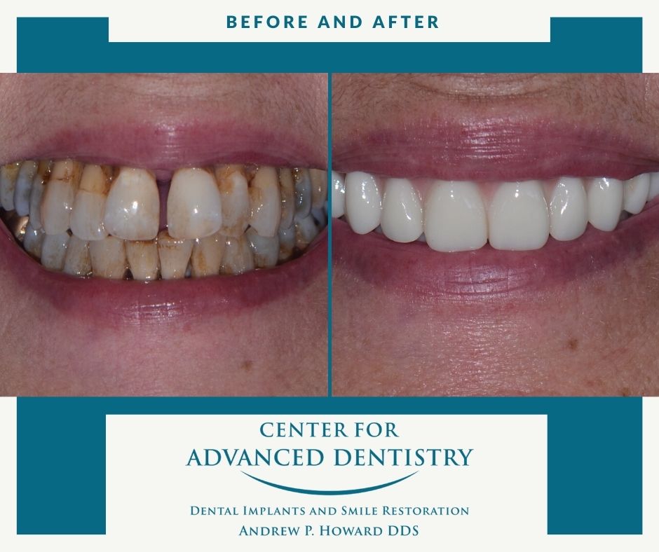 smiles before and after treatment